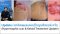 Update เทคนิคดูแลแผลเป็นนูนคีลอยด์ ครับ (Hypertrophic scar & Keloid Treatment Update)